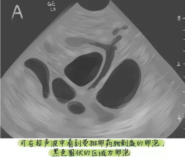 试管婴儿全套流程，3分钟看懂试管婴儿全过程