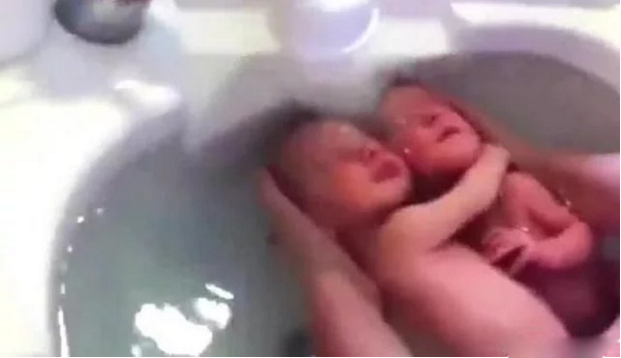 剖腹产下双胞胎男婴，看到他们时，医生都笑了，感叹兄弟情深