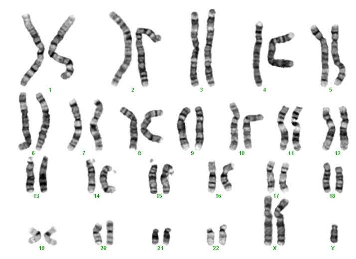 当试管婴儿遇见染色体异常怎么办？