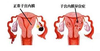 子宫内膜异位症