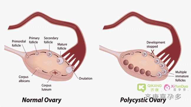 解析多囊卵巢综合征