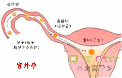 宫外孕是怎么回事