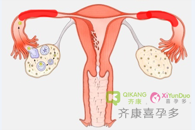 宫外孕是怎么引起的