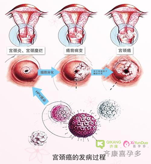 得了宫颈癌还能拥有自己的孩子吗？