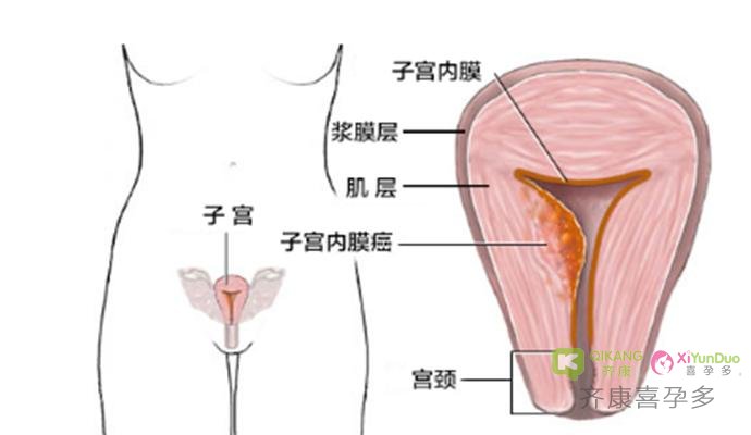 子宫内膜薄怎么办