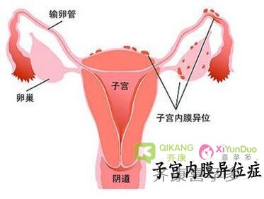 子宫内膜异位症能做试管婴儿吗？术前需要先治疗吗？