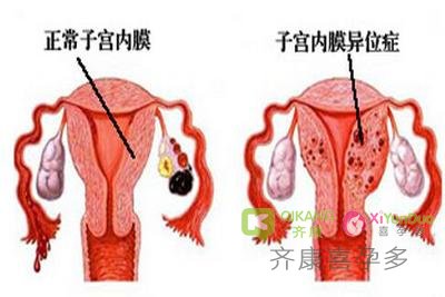 子宫内膜异位症能做试管婴儿吗？术前需要先治疗吗？