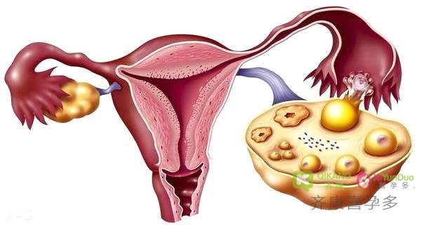 试管中出现卵巢过度刺激综合征是什么情况？