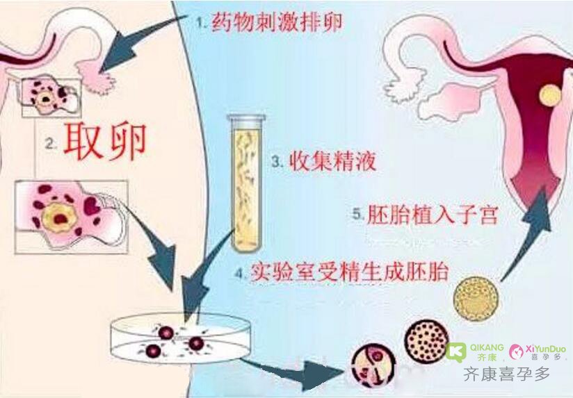 试管婴儿移植该使用冻胚还是鲜胚？情况也许并没那么理想