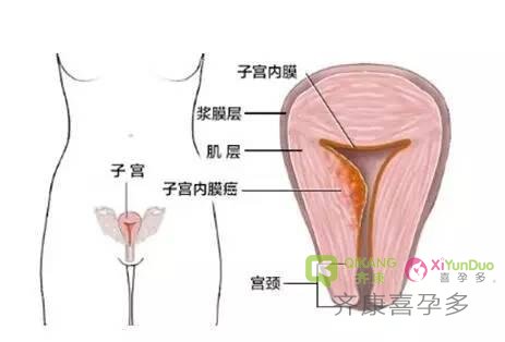 试管过程中子宫内膜薄怎么应对才有效果