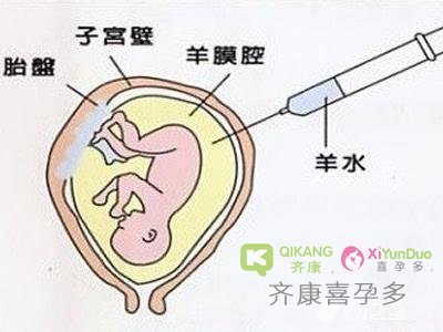 羊水穿刺对胎儿有没有危险，哪些孕妇需要做