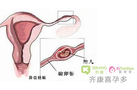 宫外孕输卵管切除，影响做泰国试管马来西亚试管吗？