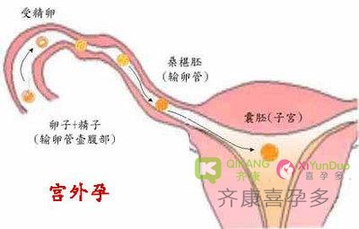 宫外孕输卵管切除，影响做泰国试管马来西亚试管吗？