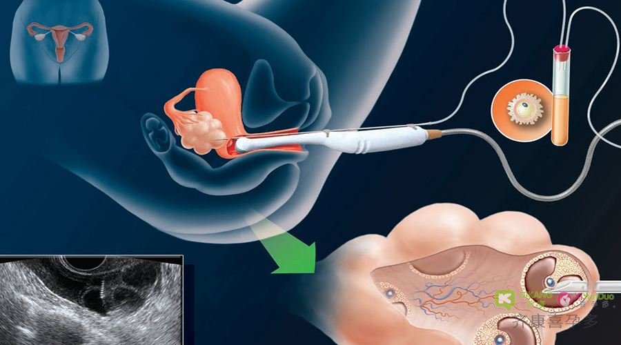 泰国试管婴儿促排取卵对卵巢有什么影响？会造成卵巢早衰吗？