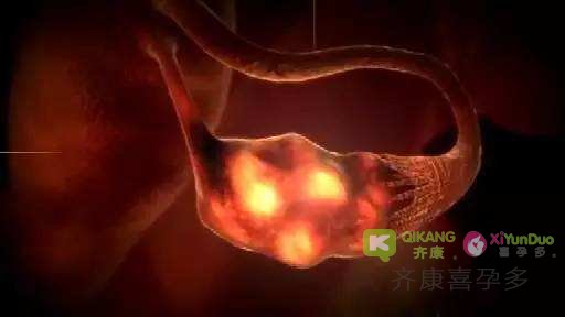 泰国试管婴儿促排取卵对卵巢有什么影响？会造成卵巢早衰吗？