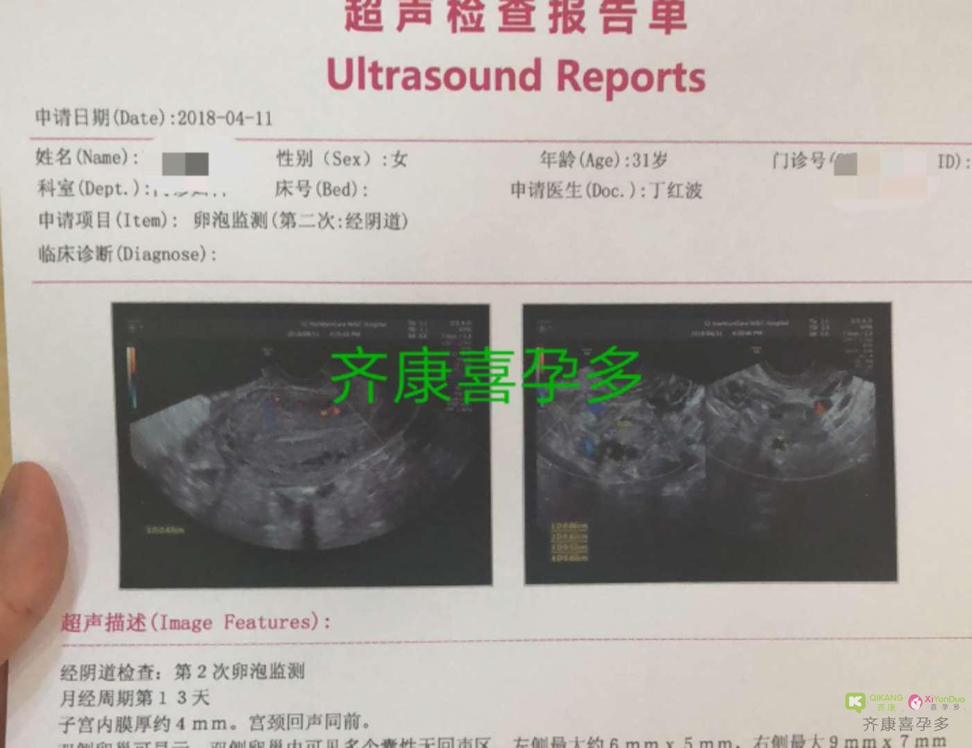 卵巢功能发育不良 卵巢早衰 马来西亚三代试管一次成功男宝!