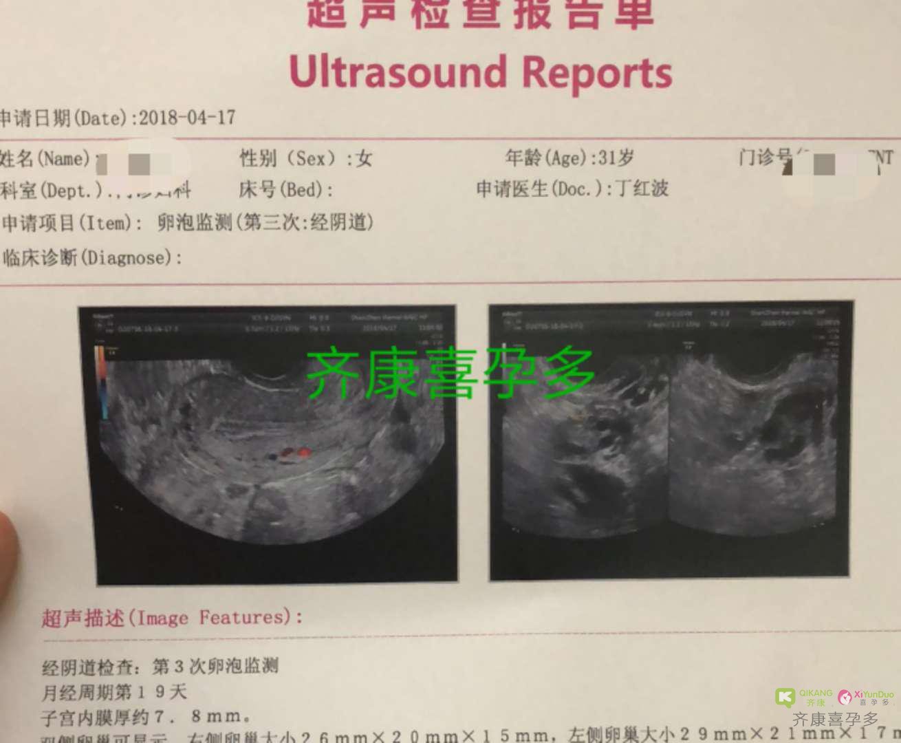 卵巢功能发育不良 卵巢早衰 马来西亚三代试管一次成功男宝!