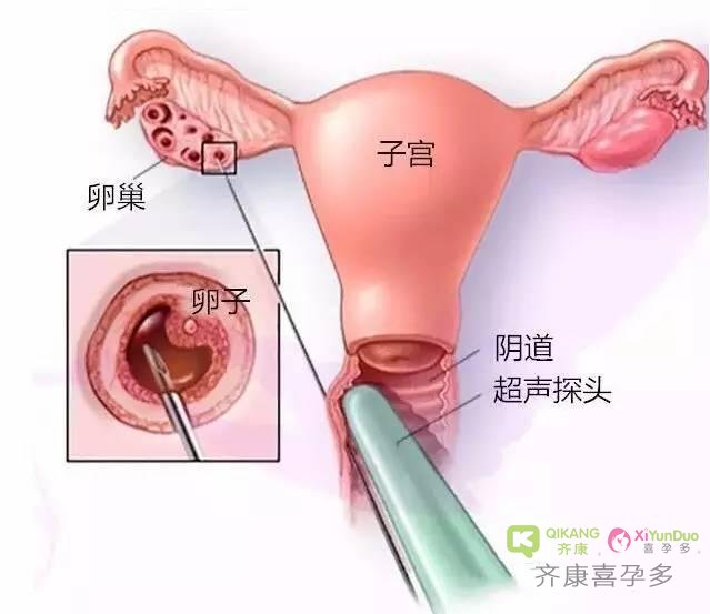 “无痛取卵”真的无痛吗？泰国试管婴儿那点事