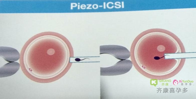 压电式胞浆内单精子注射 有效提高弱精受精率