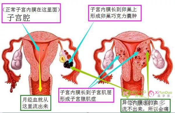 齐康喜孕多生殖小知识-----子宫内膜异位如何影响不孕的