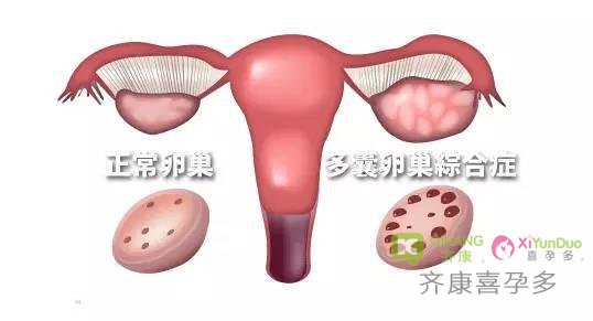 多囊患者减肥误区  试管前你减肥成功了吗？