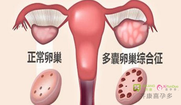 齐康喜孕多孕育小知识：有多囊的女性应该如何科学的备孕