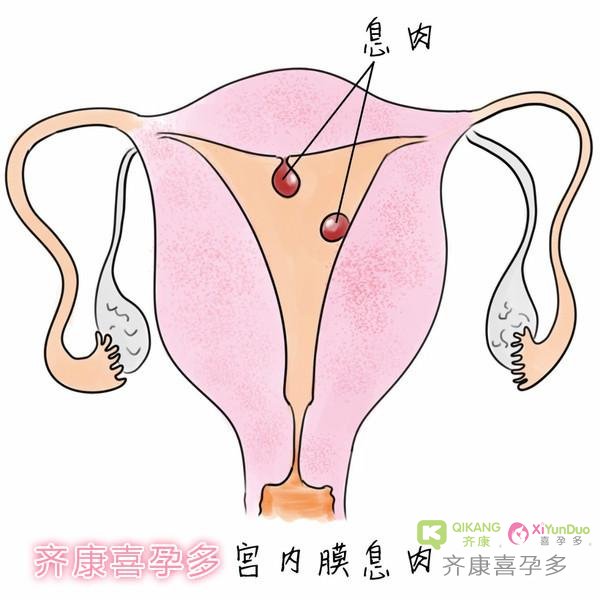 知识普及：做试管婴儿治疗前子宫内膜薄应当怎么去调理内膜？
