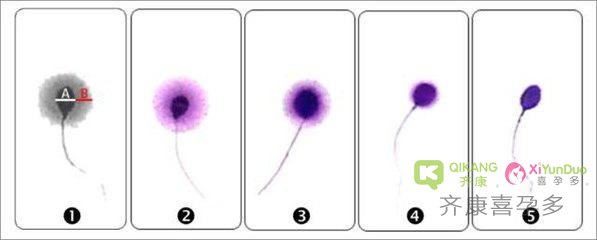 影响海外试管成率的因素：精子DNA碎片率是怎么回事？