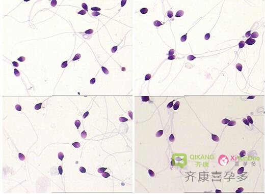 影响海外试管成率的因素：精子DNA碎片率是怎么回事？
