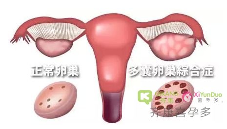 多囊卵巢可以去泰国做试管婴儿吗？试管前需要怎么调理？