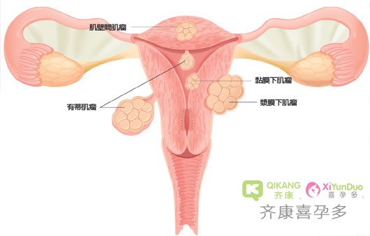 子宫肌瘤影响做试管吗？面对子宫肌瘤泰国试管该如何进行下去呢？
