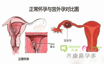 宫外孕是怎么引起的？试管婴儿能避免宫外孕吗？