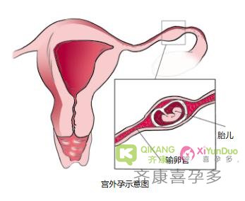 宫外孕是怎么引起的？试管婴儿能避免宫外孕吗？