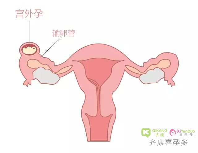 宫外孕是怎么引起的？试管婴儿能避免宫外孕吗？