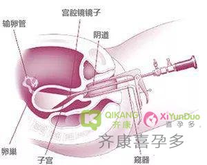 【试管小课堂】宫腔镜有什么用途？哪种情况下需要做宫腔镜检查？