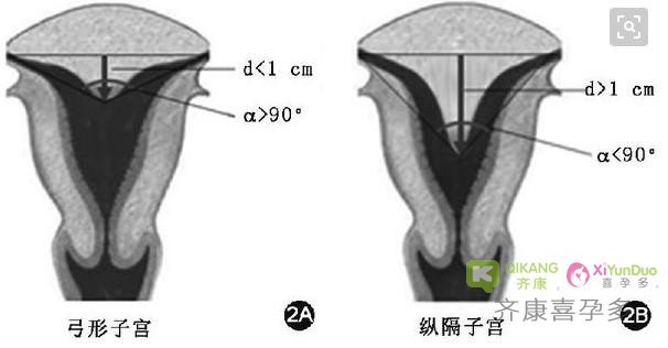 弓形子宫能正常生育吗？弓形子宫是否影响三代试管最后结局？