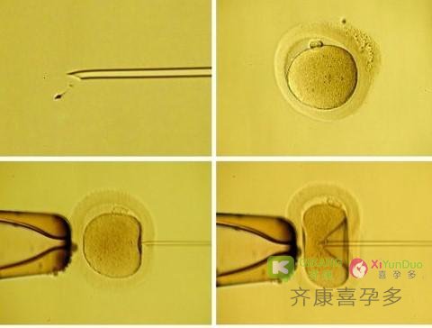 喜孕多小课堂：ICSI和IMSI有什么不同？带你了解试管中单精子注射技术