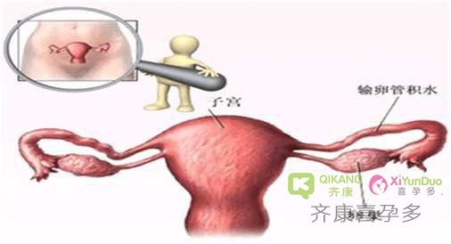 输卵管积水不孕|试管婴儿遇到输卵管积水该怎么破？