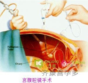 输卵管积水不孕|试管婴儿遇到输卵管积水该怎么破？