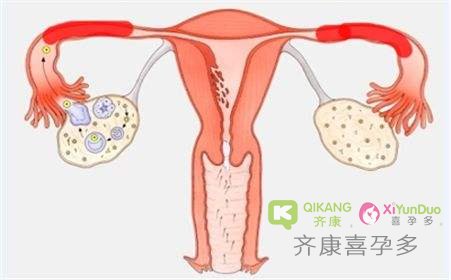 输卵管积水能自愈吗？为什么会引起不孕？影响做试管吗？【全】