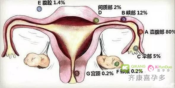 泰国试管婴儿也会出现宫外孕吗