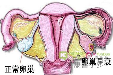 泰国试管婴儿：卵巢功能减退怎么破？