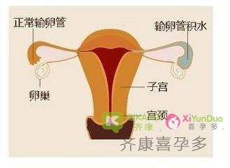 齐康喜孕多泰国试管婴儿专家告诉您输卵管有积水，影响做试管吗？