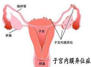 子宫内膜异位症能做泰国试管婴儿吗 乌克兰合法代Y也是一个选择