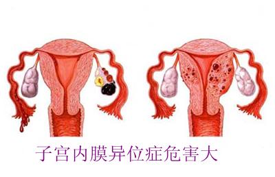 子宫内膜异位症能做泰国试管婴儿吗 乌克兰合法代Y也是一个选择