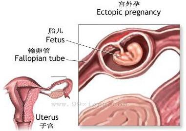 三代试管婴儿能避免宫外孕吗？胚胎是否着床不是试管能解决的问题