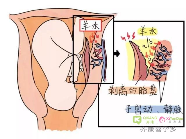 齐康喜孕多告诉你羊水有多可怕，该怎样预防？