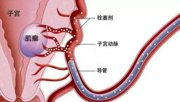 子宫切除后如何拥有自己的孩子？乌克兰合法代Y帮您忙！