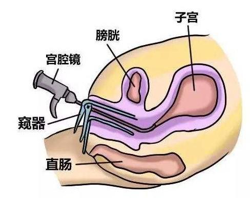 试管婴儿移植胚胎之前要做宫腔镜吗？宫腔镜检查有什么好处？