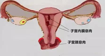 子宫上面的哪些病症影响着试管胚胎的着床成功率？